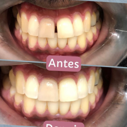 antesdepois1 antesdepois1